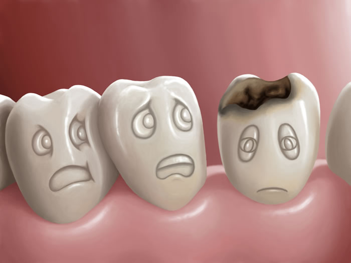 Dental Sealant- Global Estetik Dental Care